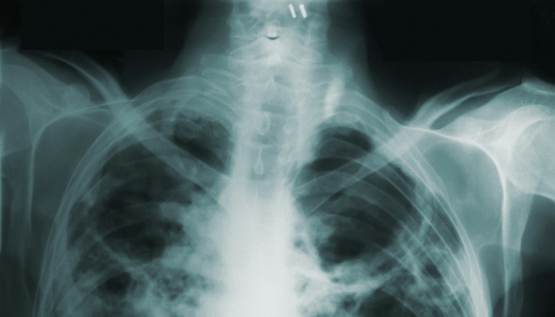 La tuberculosis vuelve a golpear a la Argentina